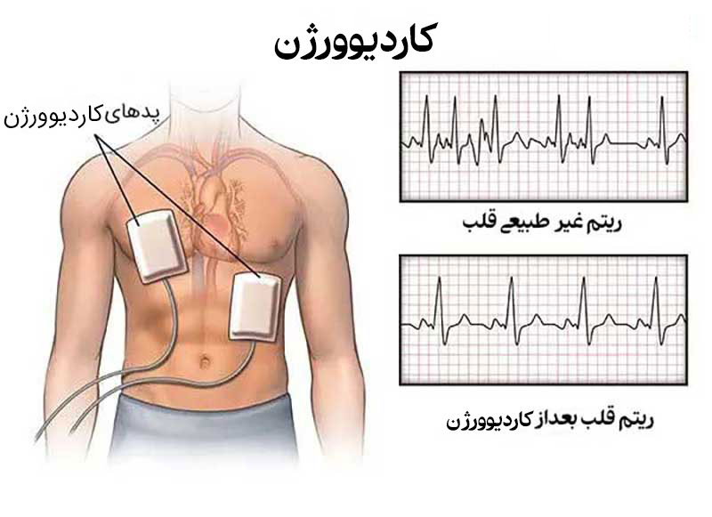 کاردیوورژن