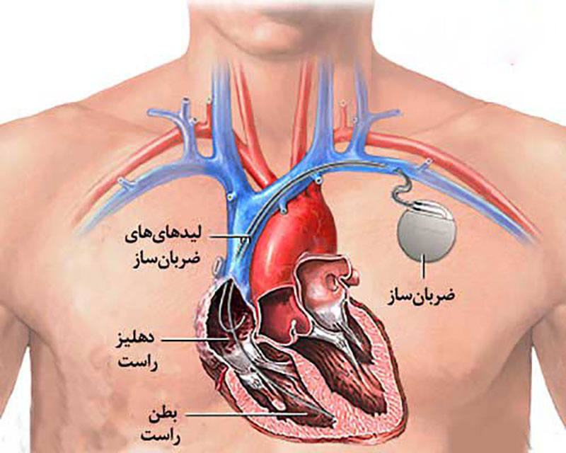 ضربان ساز