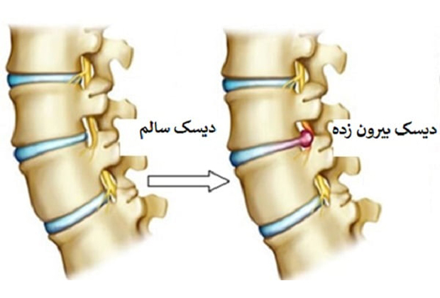 بیرون زدگی دیسک کمر