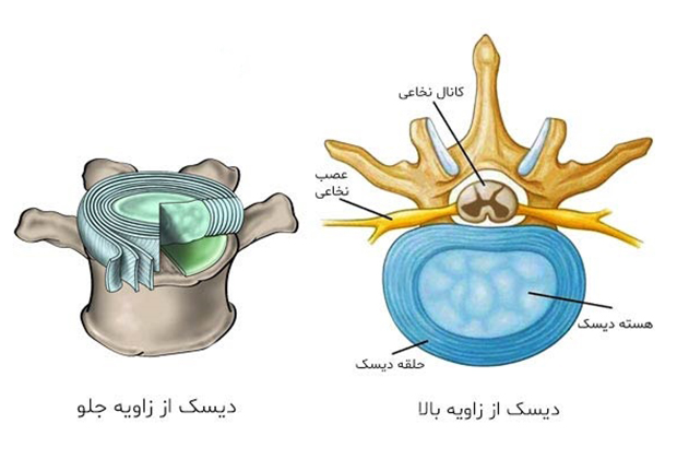 دیسک کمر