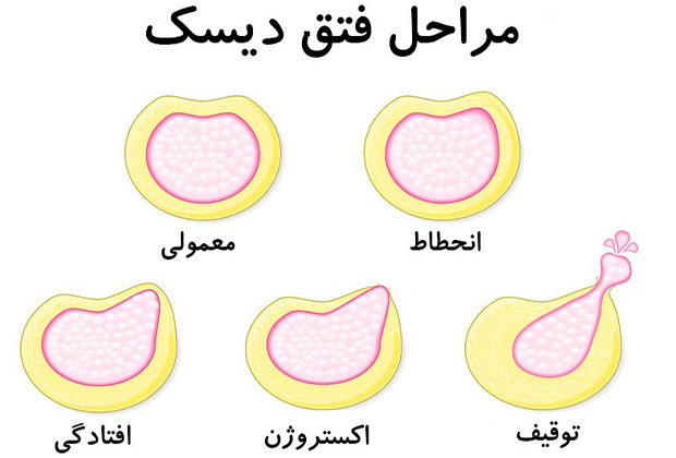 فتق کمر