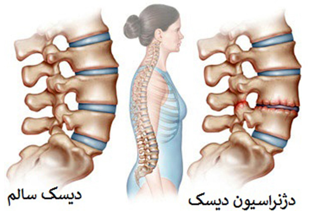 دیسک کمر