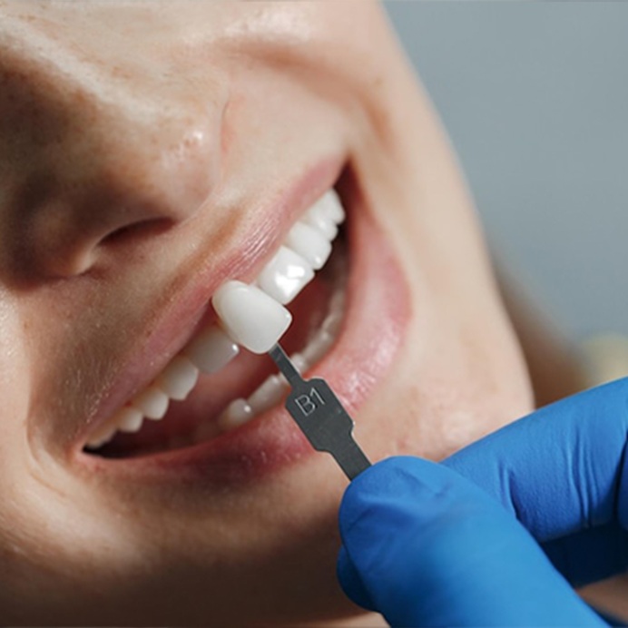 ایمپلنت دندان